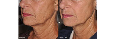 Vorher Nachher Bild Gesicht und Hals nach Radiofrequenz Microneedling Behandlung